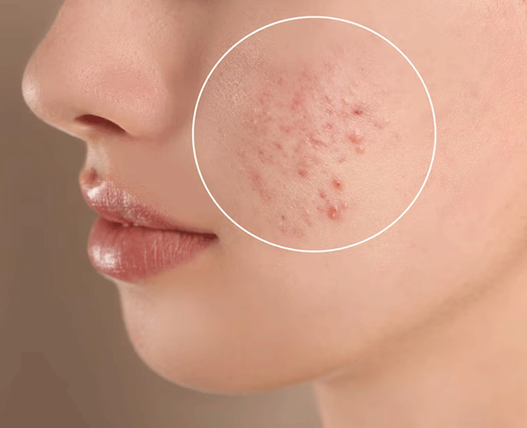 جوش از نوع لک های پوستی صورت