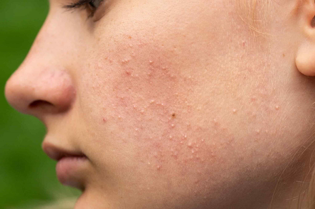 نمونه آکنه روی صورت خانوم ها