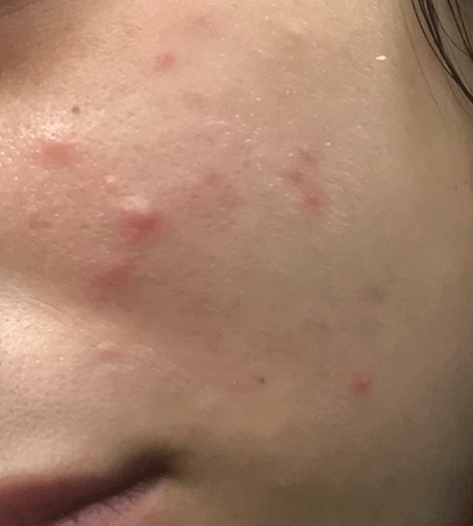 پاپول از نوع لک های پوستی صورت