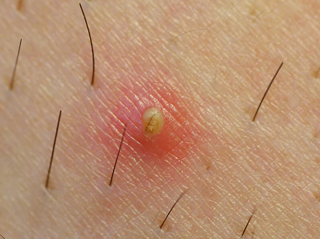 موی زیر پوستی از نوع لک های پوستی صورت