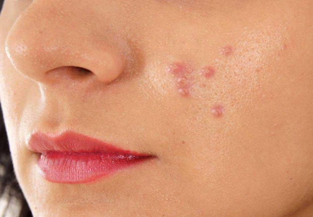 عکس آکنه ولگاریس روی صورت خانوم ها