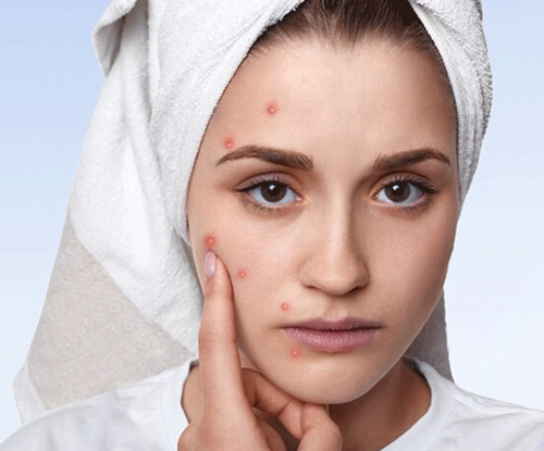 پوسچول از نوع لک های پوستی صورت